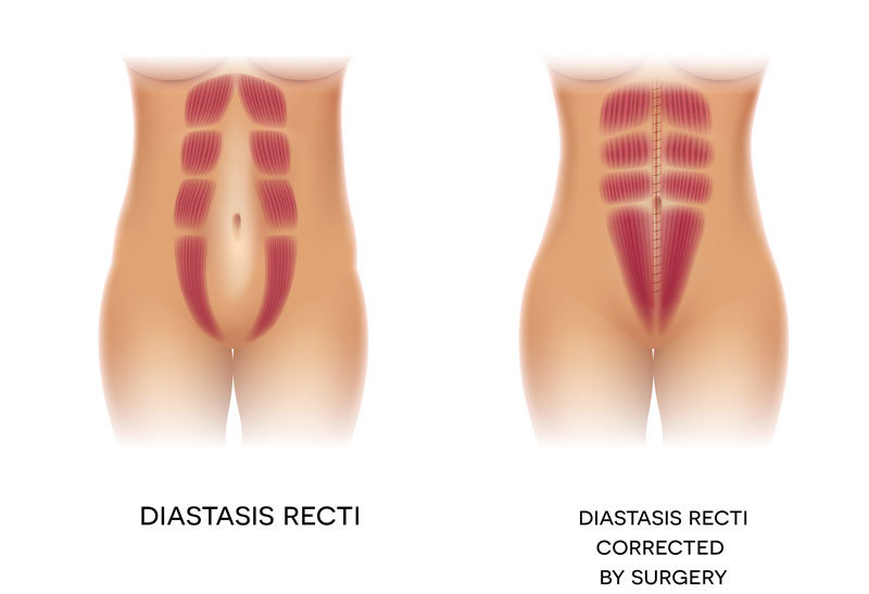 Animated diagram of the abdominal muscles