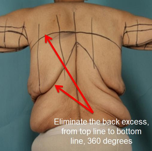 Upper body lift instructions labeled over a male patient - back view