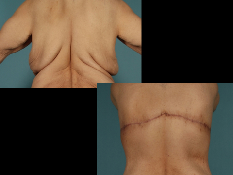 Before and after upper body lift on a male patient - back view