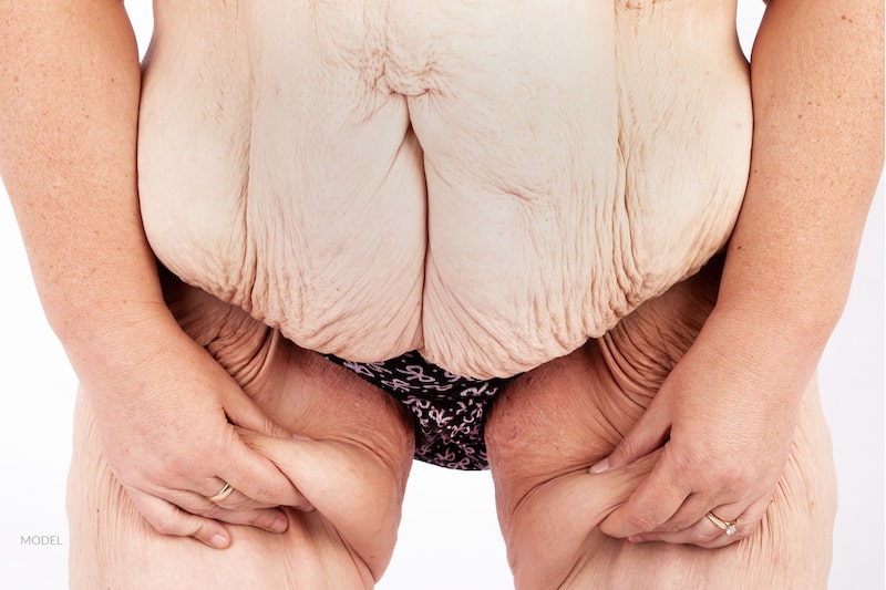 Middle-aged woman with excessive sagging skin after having lost significant amounts of weight