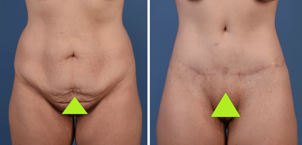 Before and after TULUA abdominoplasty.