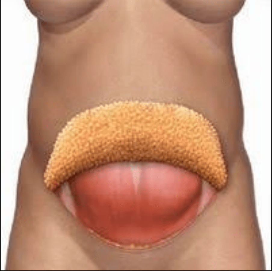 Illustration of skin flap used in TULUA abdominoplasty.