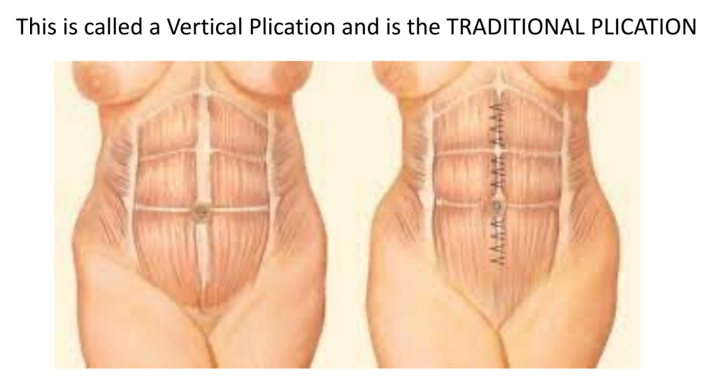 Illustration of vertical plication technique in tummy tuck.