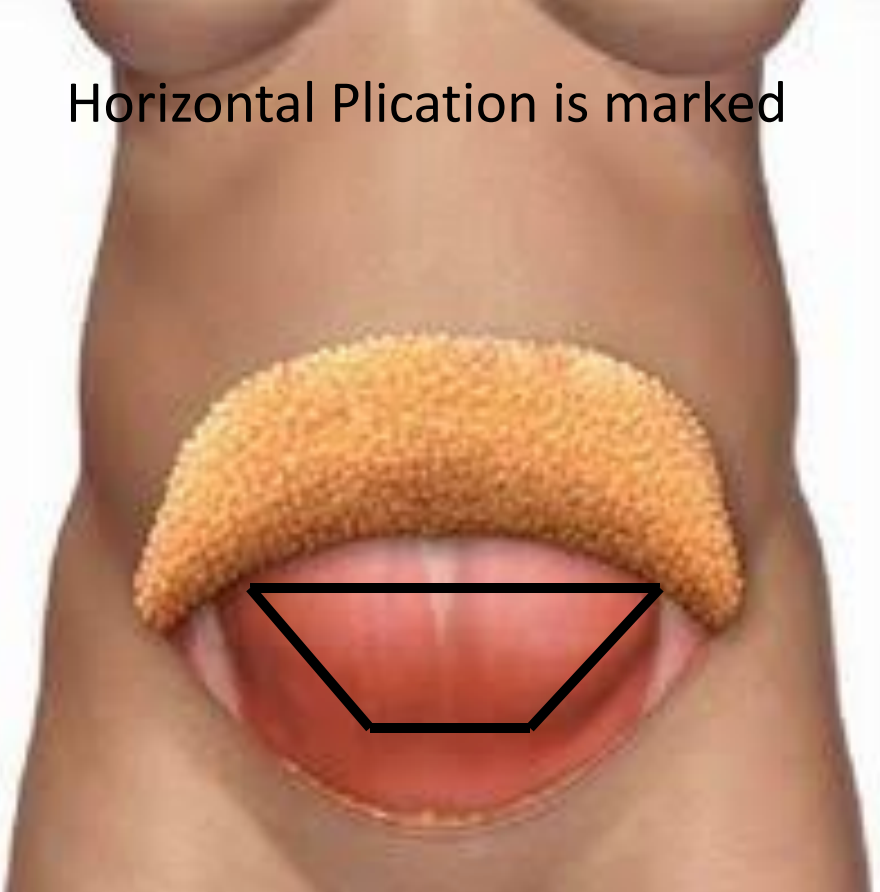 Illustration of horizontal plication used in TULUA.