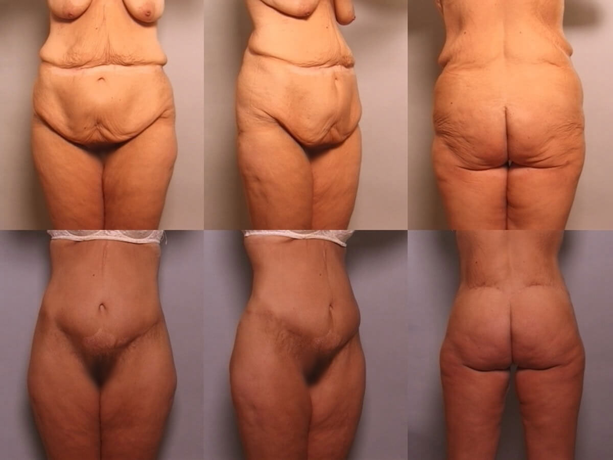 Belt Lipectomy Patient 10 | Before and After Body Lift / Belt Lipectomy 1