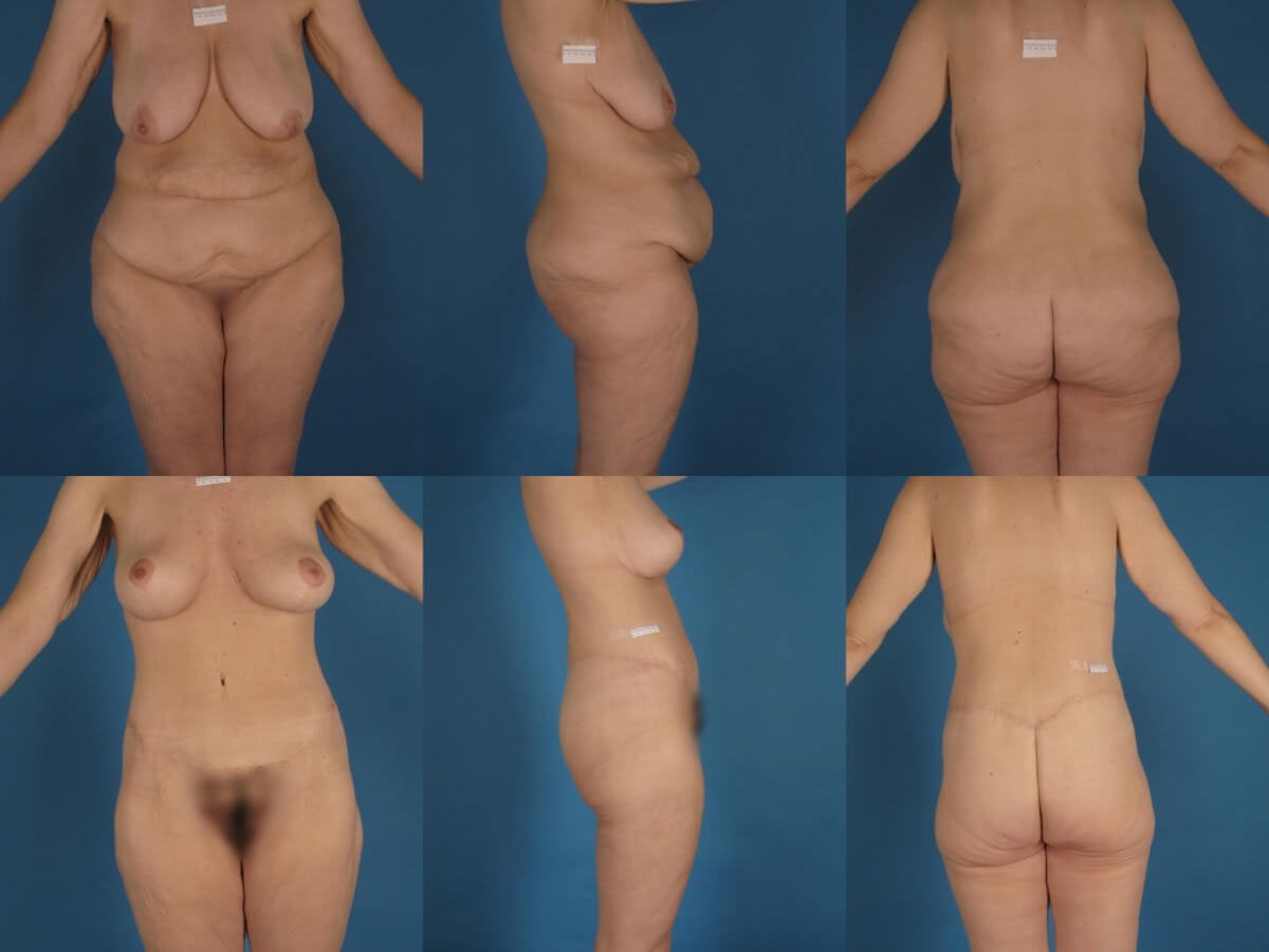 Belt Lipectomy Patient 13 | Before and After Body Lift / Belt Lipectomy 1