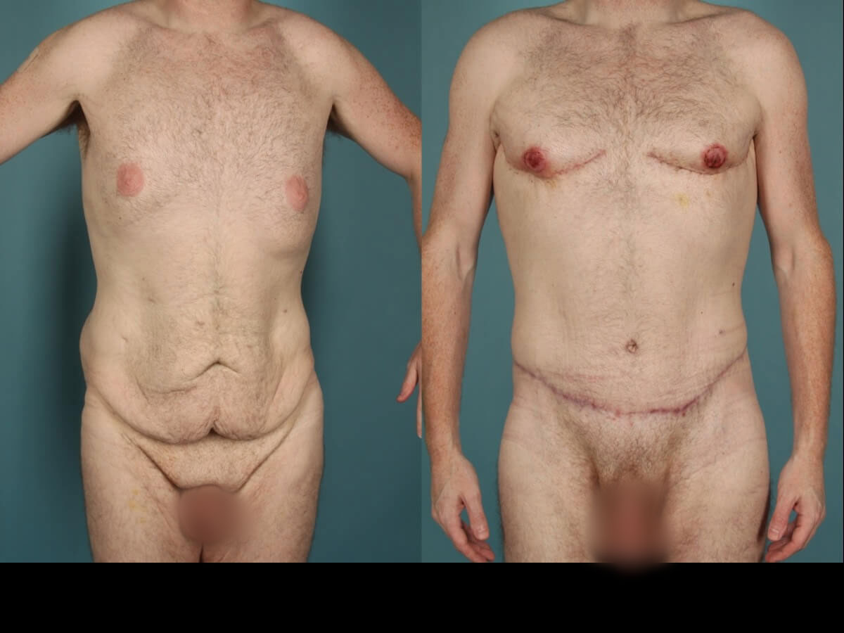 Belt Lipectomy Patient 03 | Before and After Body Lift / Belt Lipectomy 1