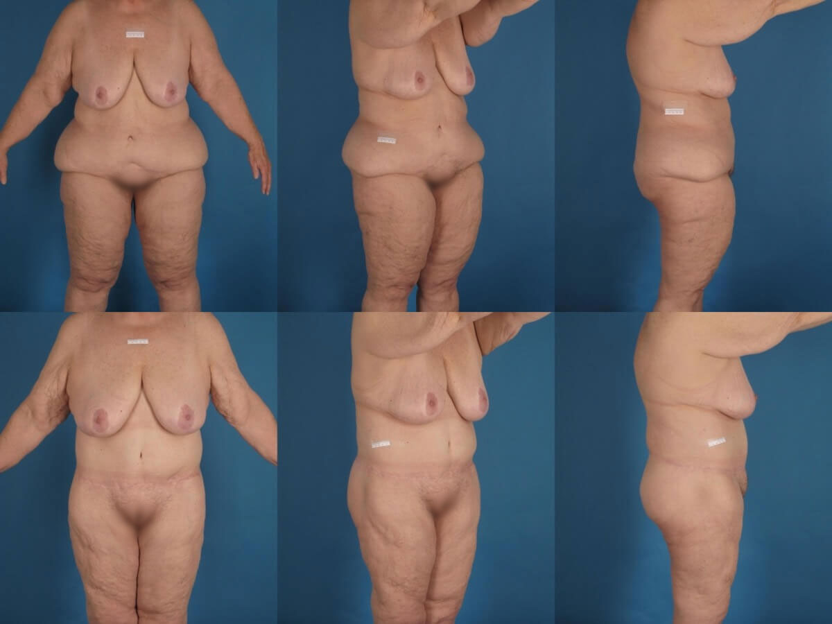 Belt Lipectomy Patient 08 - Dr. Aly - Body Contouring Specialist