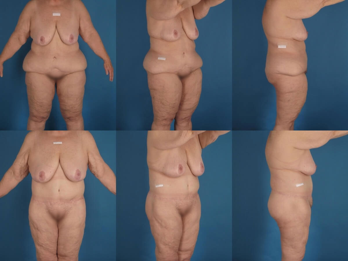 Belt Lipectomy Patient 08 | Before and After Body Lift / Belt Lipectomy 1
