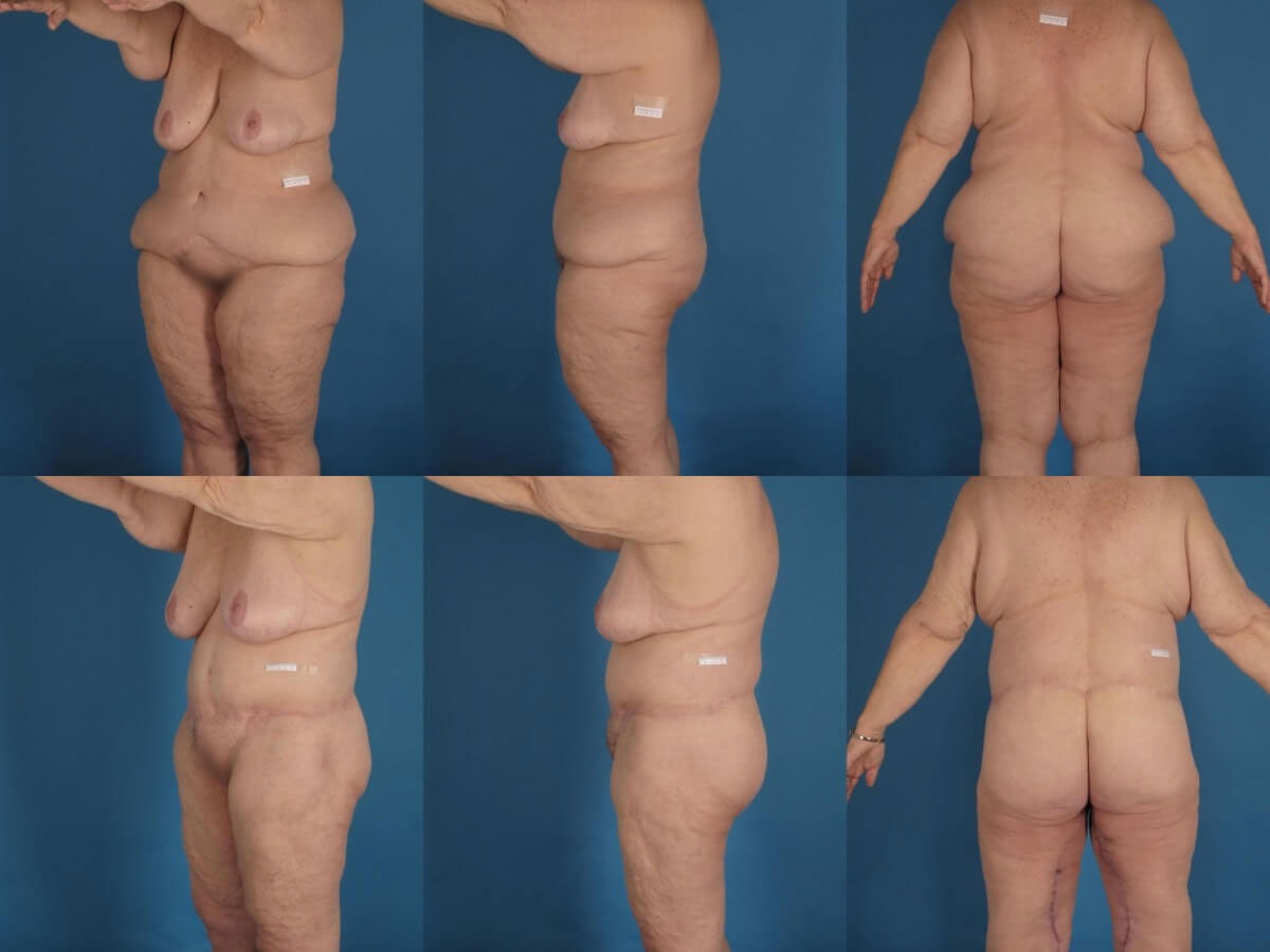 Belt Lipectomy Patient 08 | Before and After Body Lift / Belt Lipectomy 3