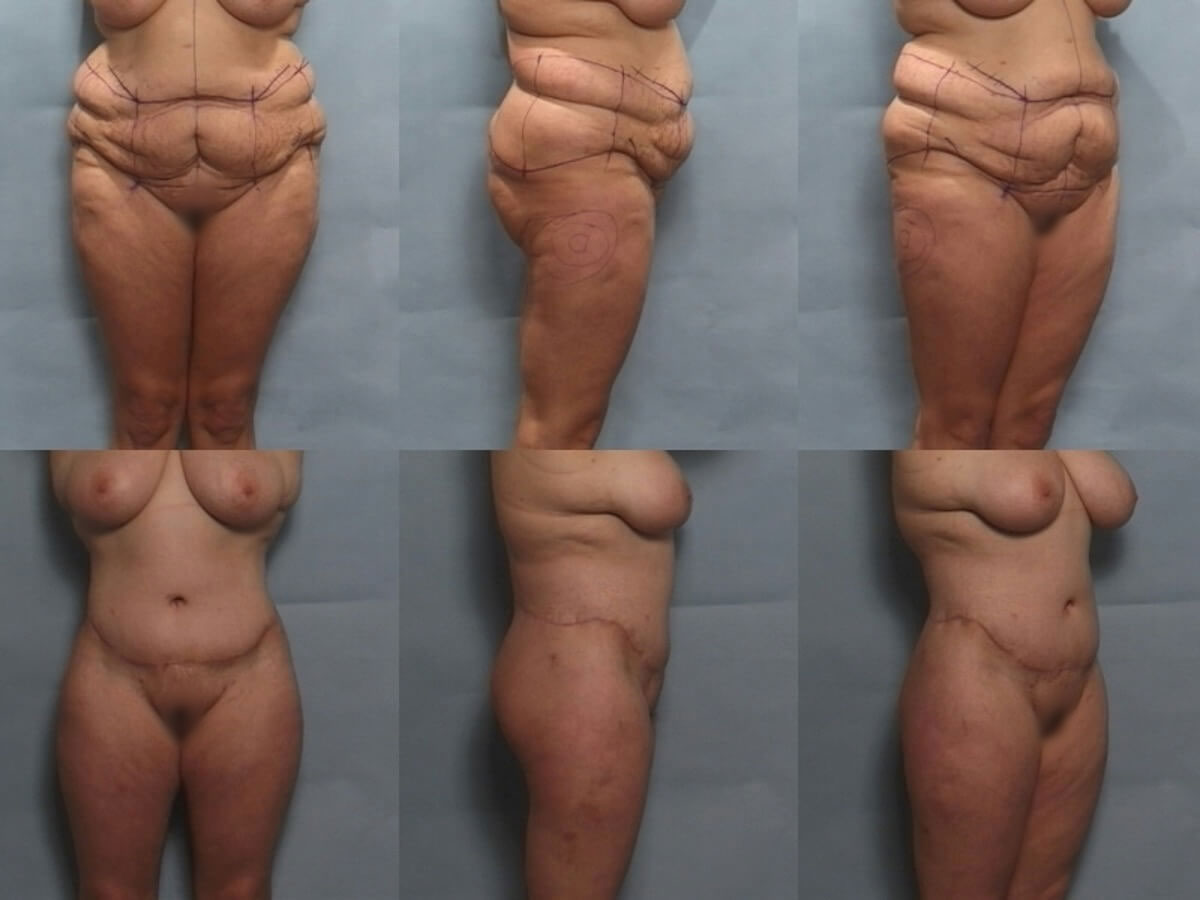 Belt Lipectomy Patient 09 | Before and After Body Lift / Belt Lipectomy 1