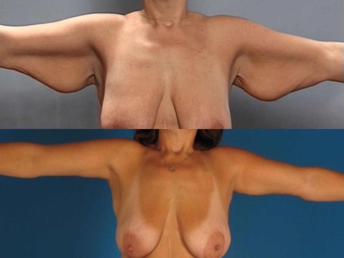 Brachioplasty Patient 01 | Before and After Arm Lift 1