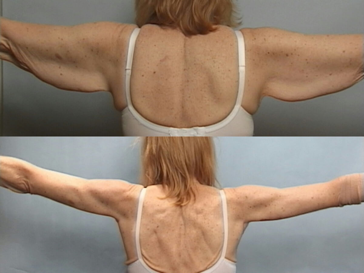 Brachioplasty Patient 2 - Dr. Aly in Dallas Texas - Before and After Patient View 2
