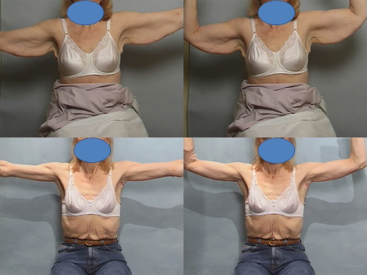 Brachioplasty Patient 2 - Dr. Aly in Dallas Texas - Before and After Patient View 3