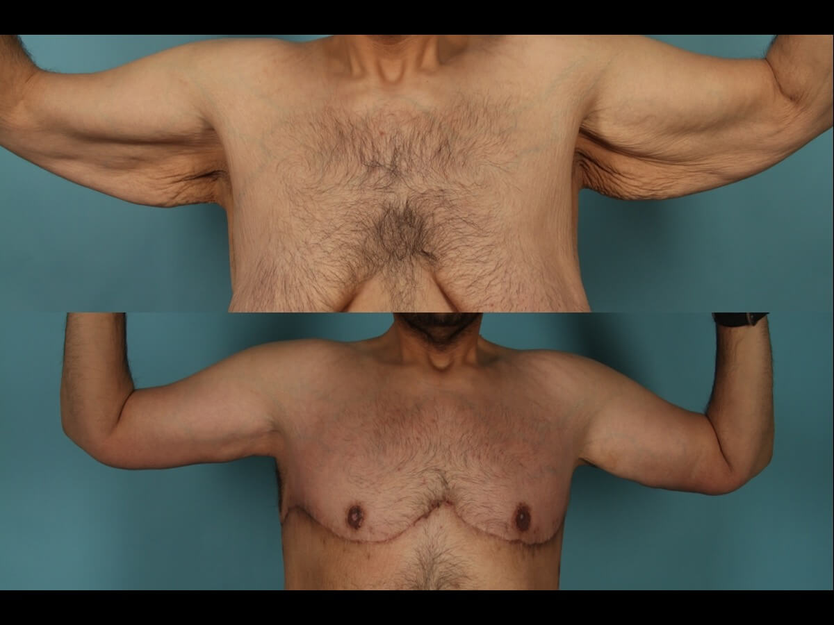 Brachioplasty Patient 3 - Dr. Aly in Dallas Texas - Before and After Patient View 1