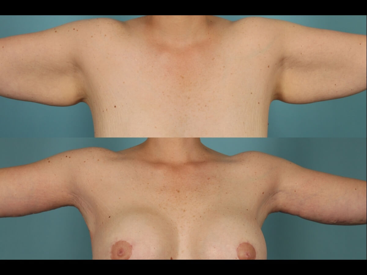 Brachioplasty Patient 05 | Before and After Arm Lift 1