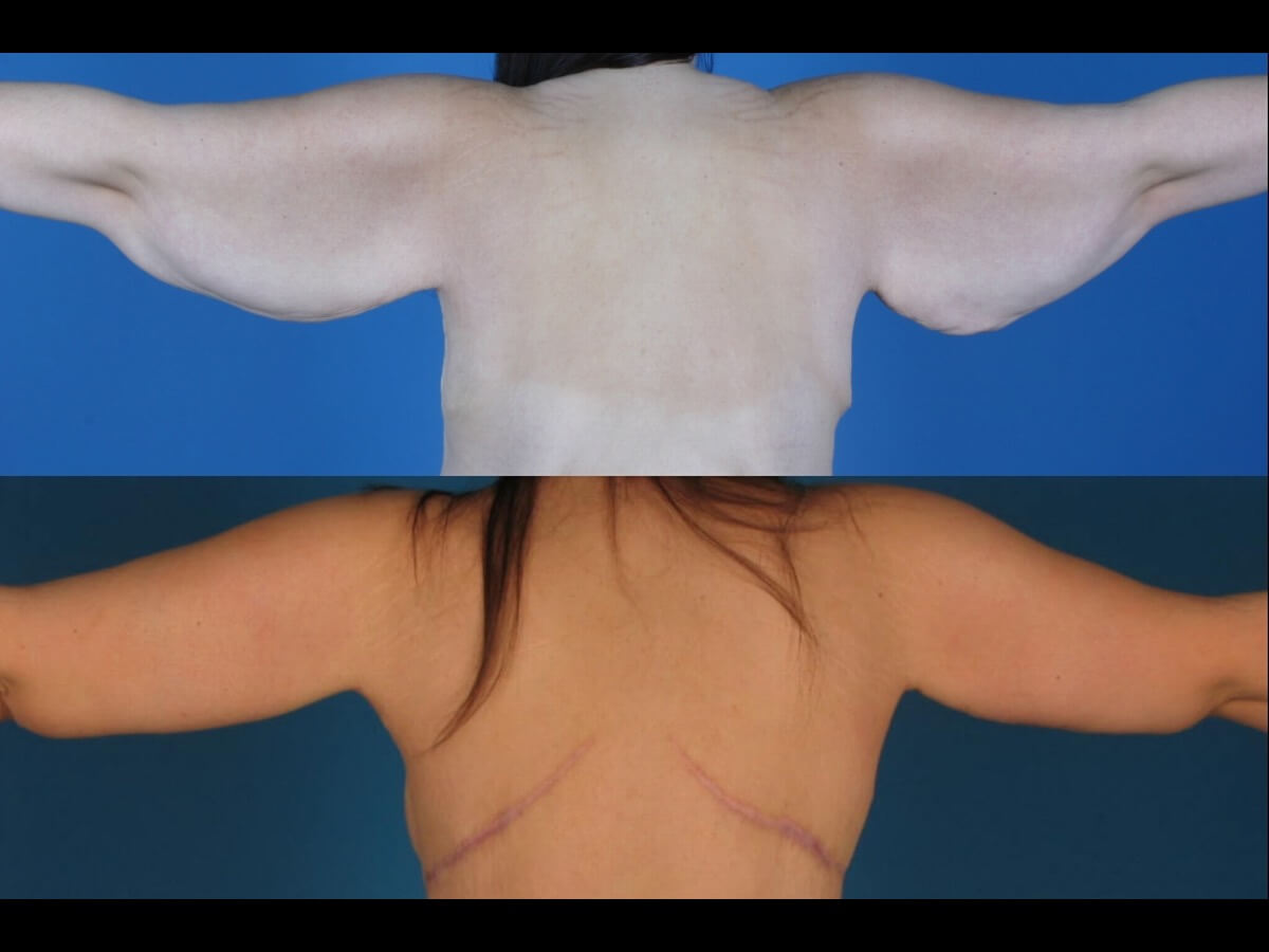 Before and After Brachioplasty for Dallas Texas Patient 7 - Back view