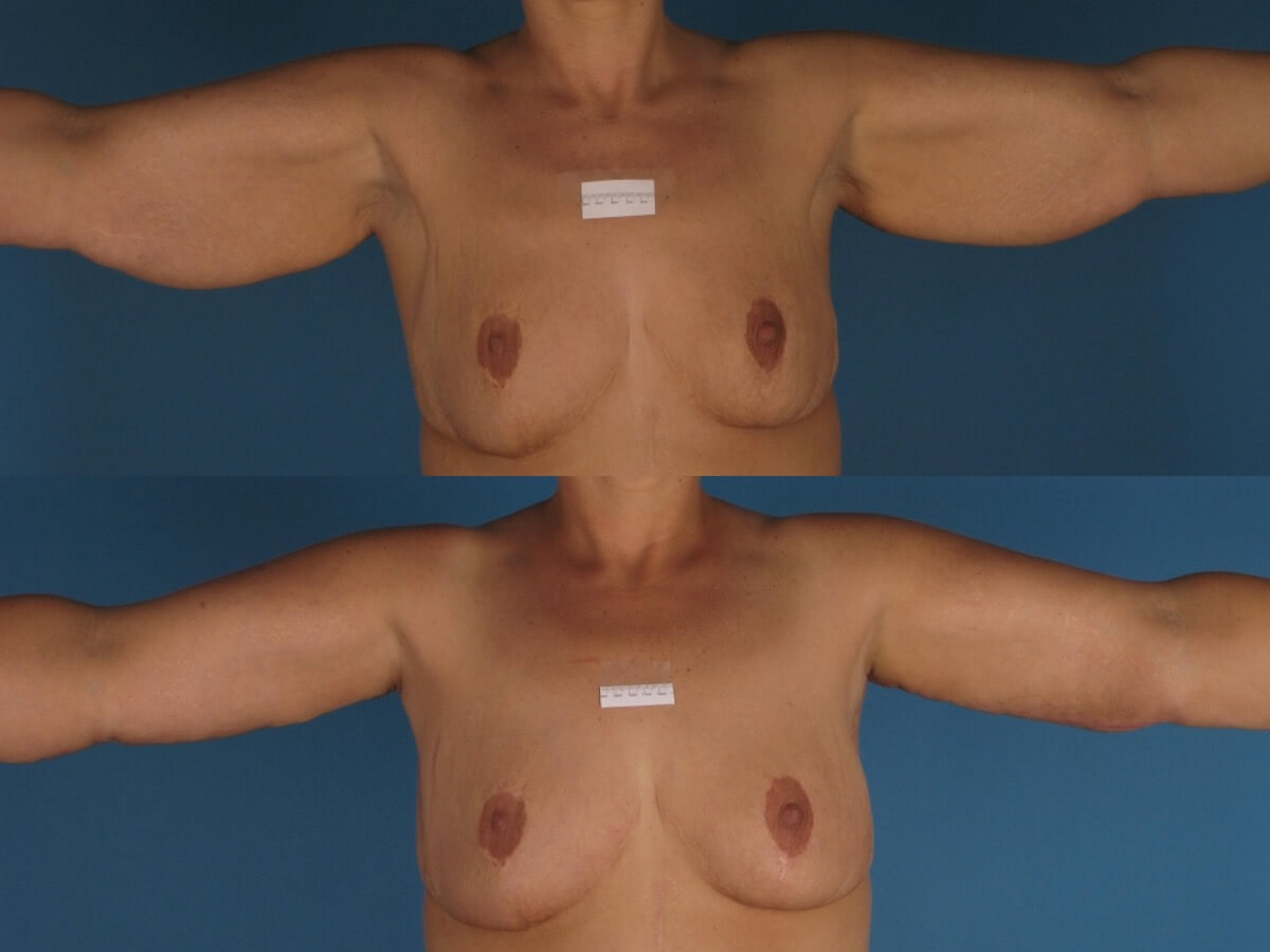 Brachioplasty Patient 09 | Before and After Arm Lift 1