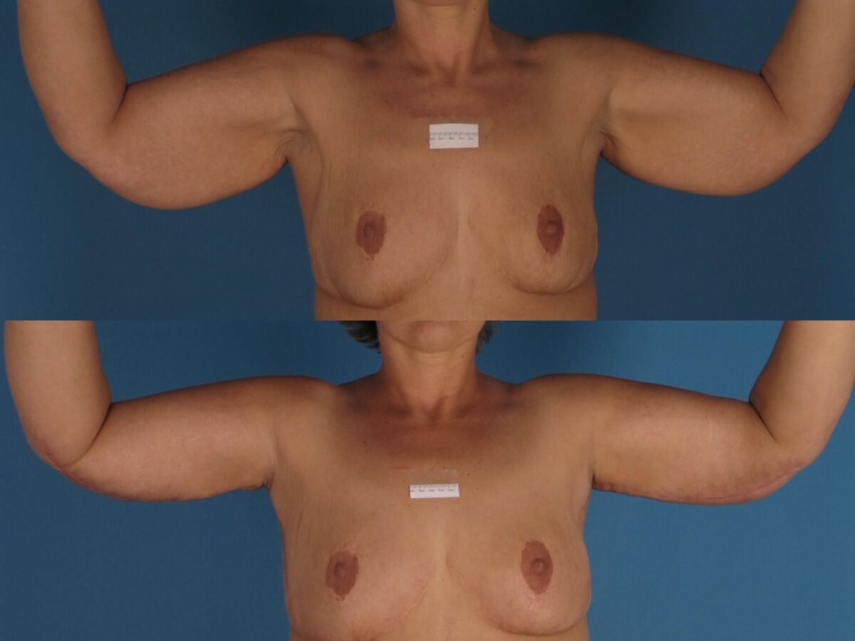 Brachioplasty Patient 09 | Before and After Arm Lift 2