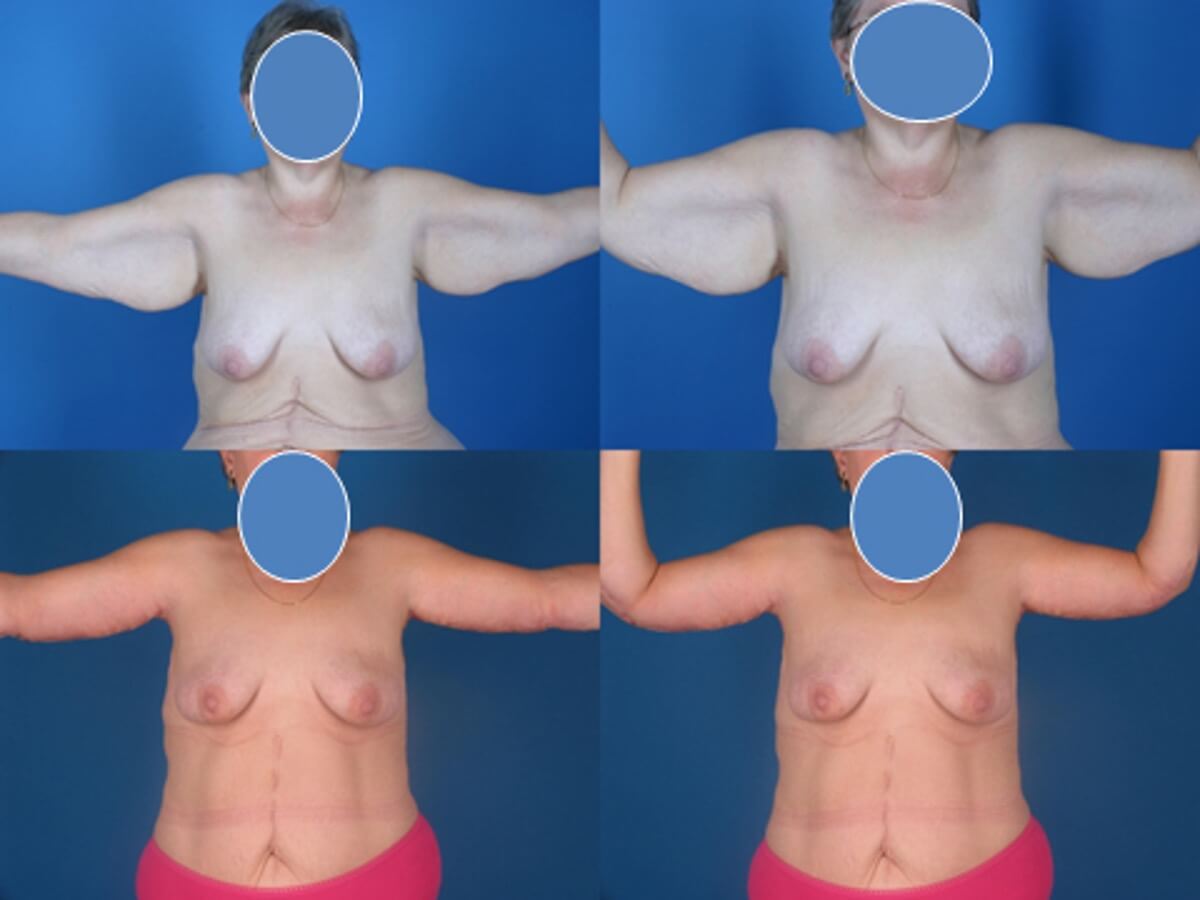 Brachioplasty Patient 10 | Before and After Arm Lift 1