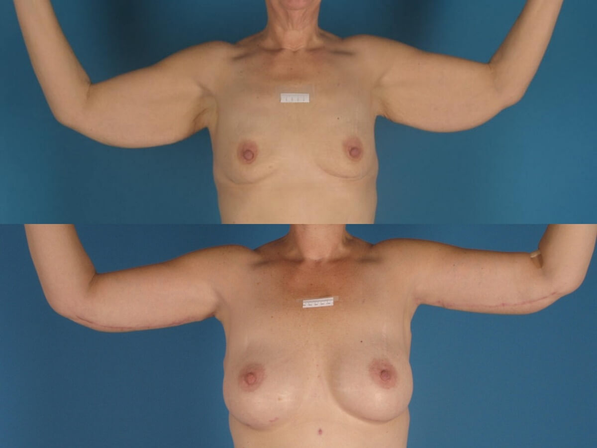 Brachioplasty Patient 11 | Before and After Arm Lift 1