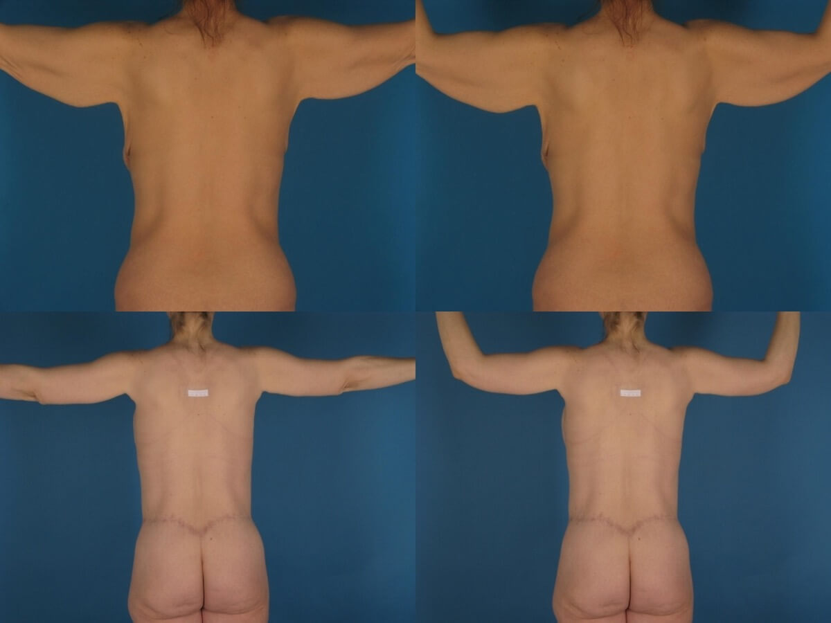 Brachioplasty Patient 12 | Before and After Arm Lift 1