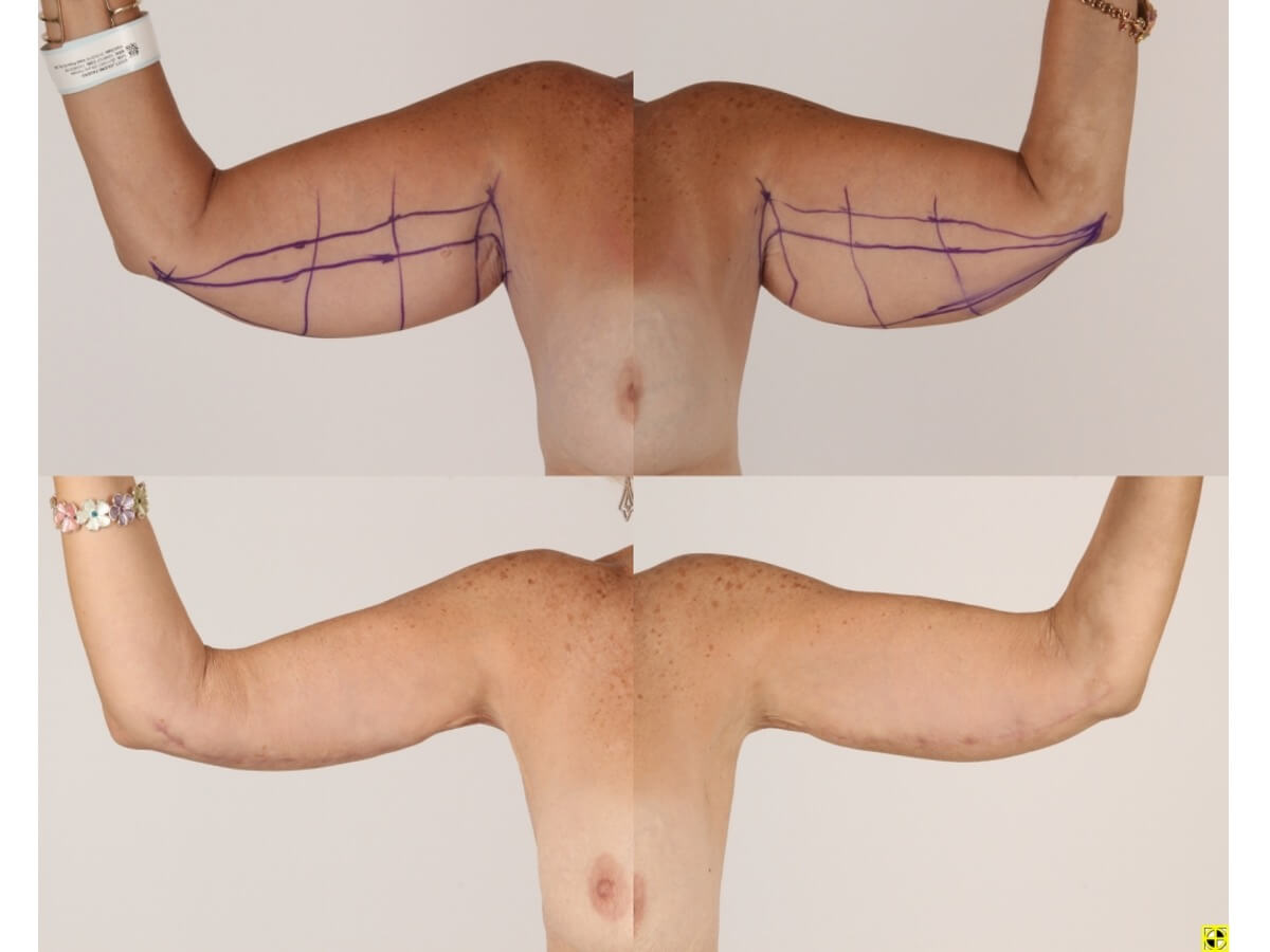 Brachioplasty Patient 15 | Before and After Arm Lift 1