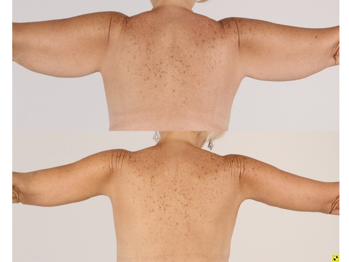 Brachioplasty Patient 15 | Before and After Arm Lift 3