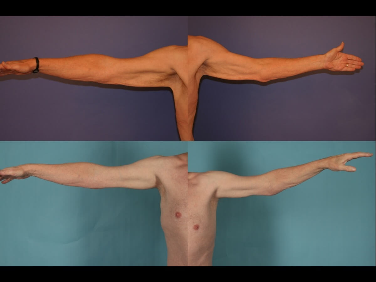 Brachioplasty Patient 16 - Dr. Aly in Dallas Texas - Before and After Patient View 1