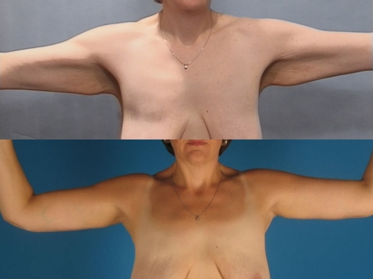 Brachioplasty Patient 17 | Before and After Arm Lift 1