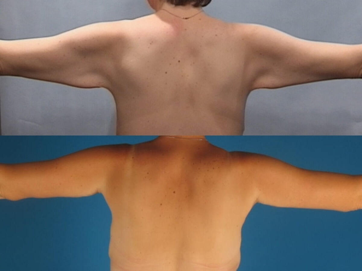 Brachioplasty Patient 17 | Before and After Arm Lift 2