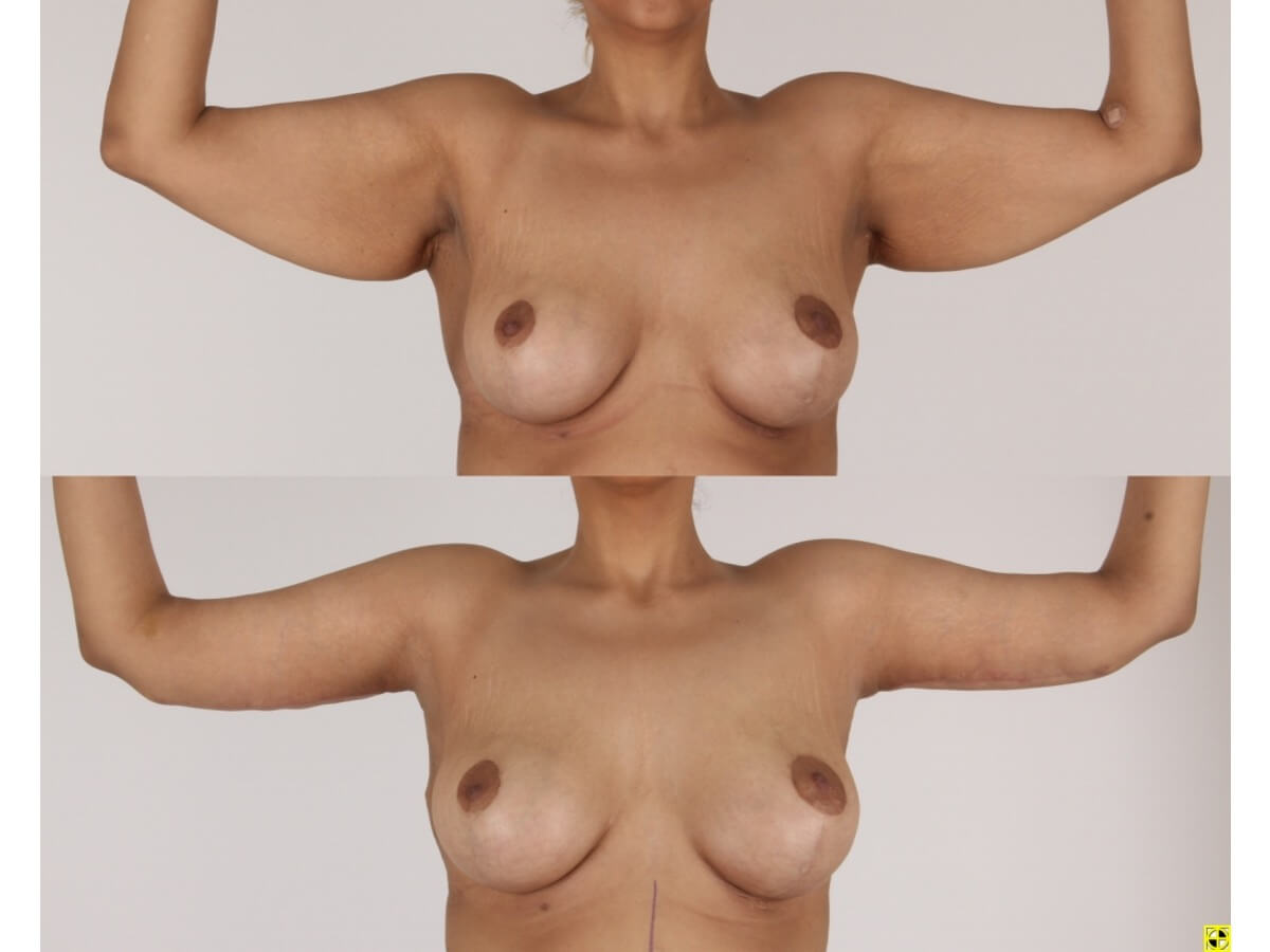 Brachioplasty Patient 19 | Before and After Arm Lift 1