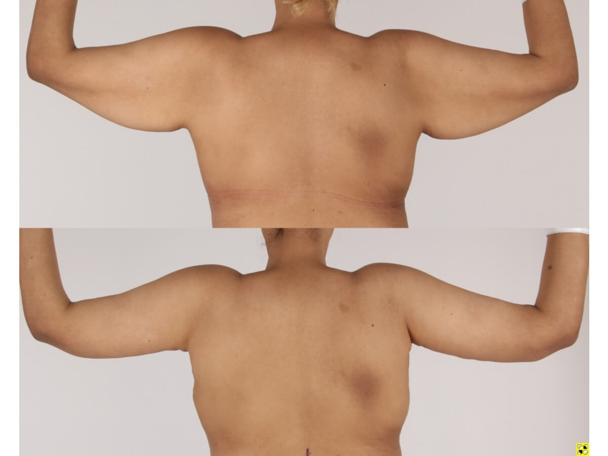 Brachioplasty Patient 19 | Before and After Arm Lift 2