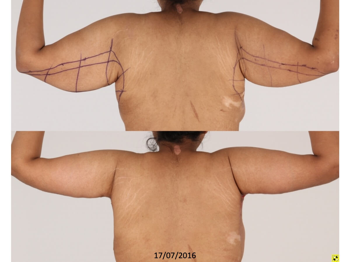 Brachioplasty Patient 20 - Dr. Aly in Dallas Texas - Before and After Patient View 1