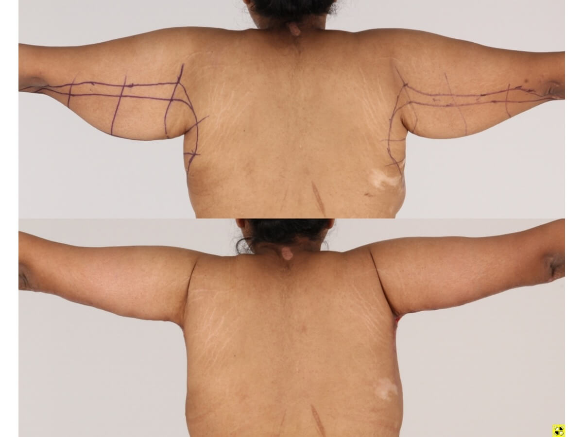 Brachioplasty Patient 35 - Dr. Aly in Dallas Texas - Before and After Patient View 2