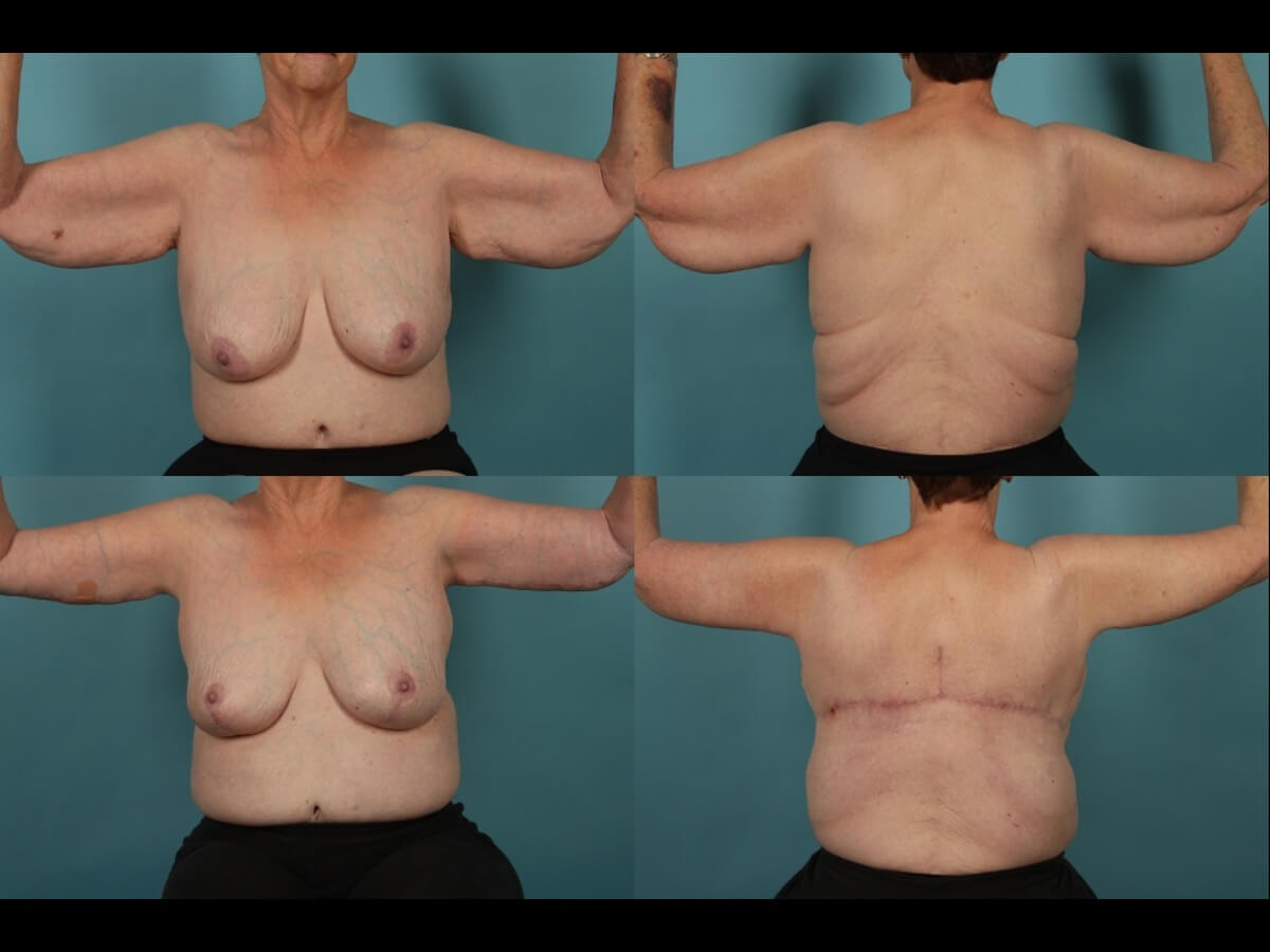 Brachioplasty Patient 22 | Before and After Arm Lift 1