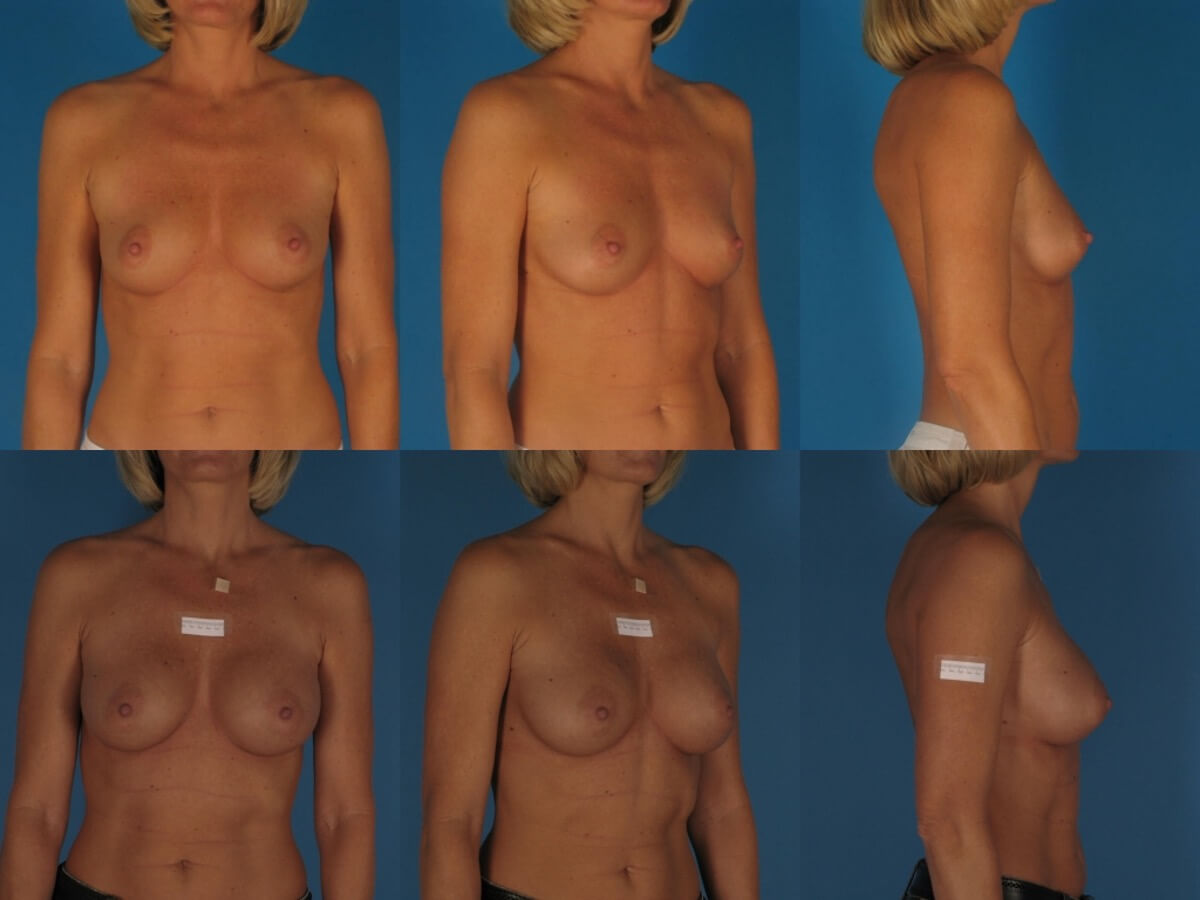 Breast Augmentation Patient 08 | Before and After Breast Augmentation 1