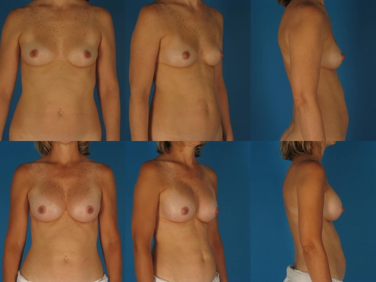 Breast Augmentation Patient 10 | Before and After Breast Augmentation 1
