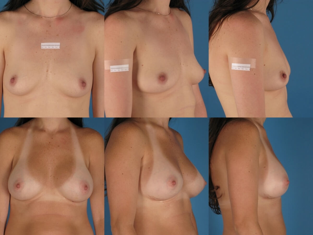 Breast Augmentation Patient 13 | Before and After Breast Augmentation 1