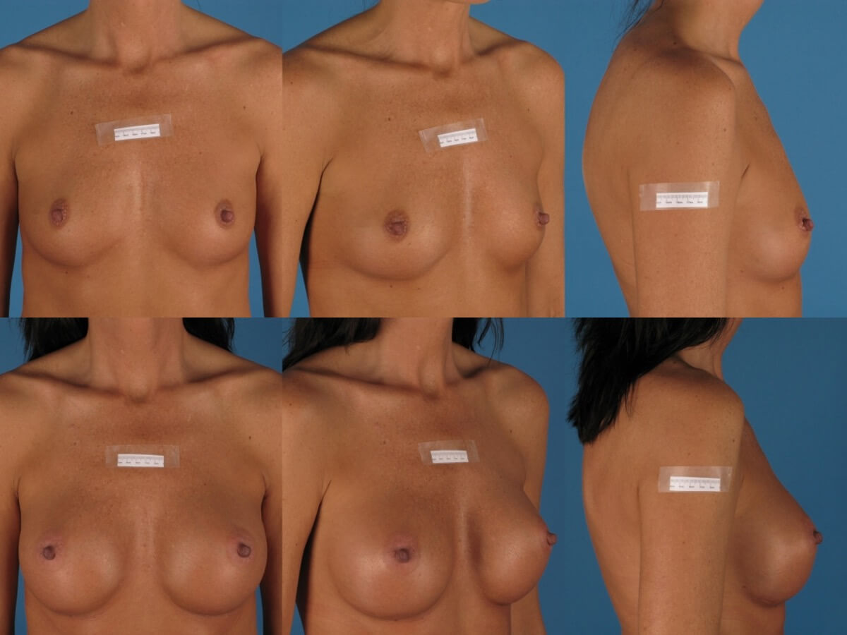 Breast Augmentation Patient 15 | Before and After Breast Augmentation 1