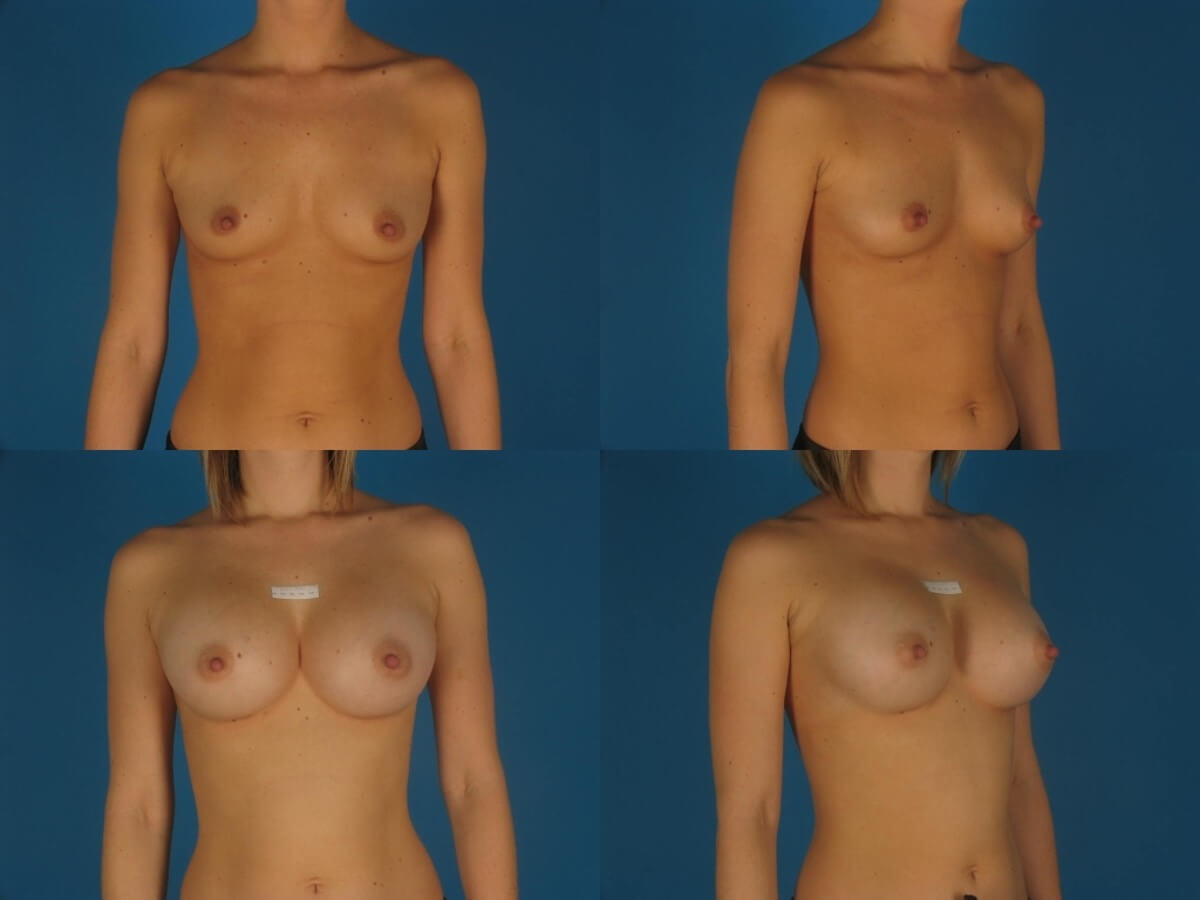 Breast Augmentation Patient 17 | Before and After Breast Augmentation 1