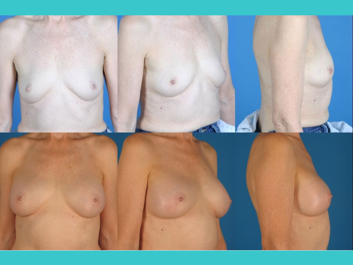 Breast Augmentation Patient 18 | Before and After Breast Augmentation 1