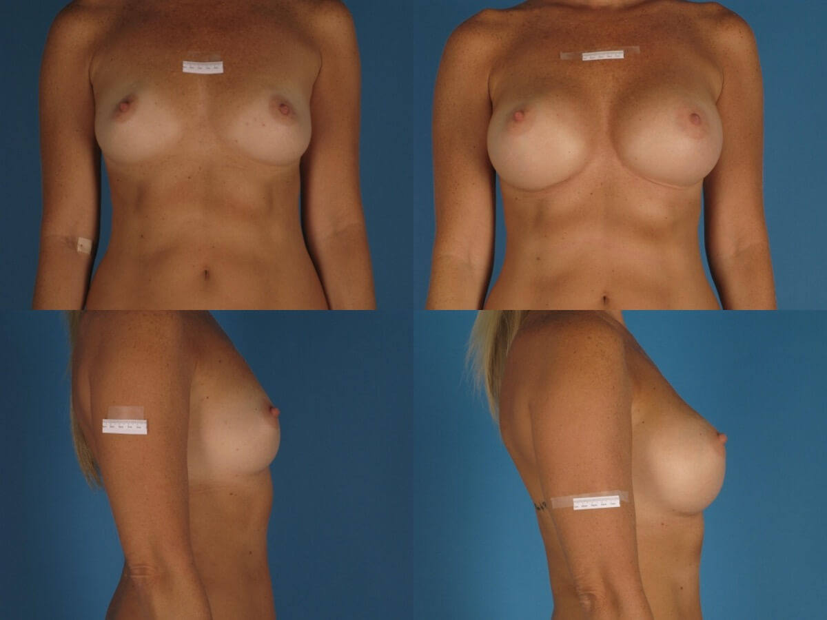 Breast Augmentation Patient 20 | Before and After Breast Augmentation 1