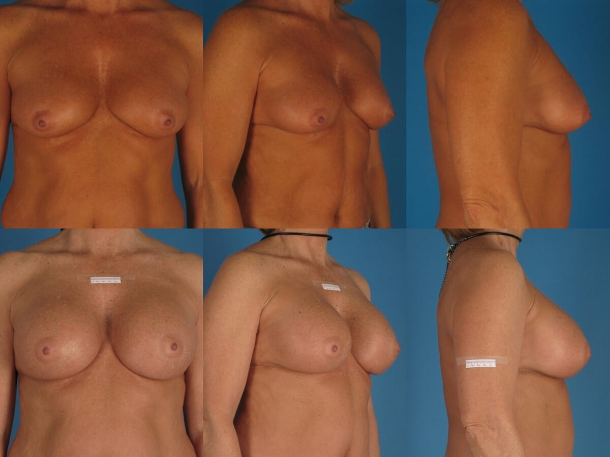 Breast Augmentation Patient 22 | Before and After Breast Augmentation 1