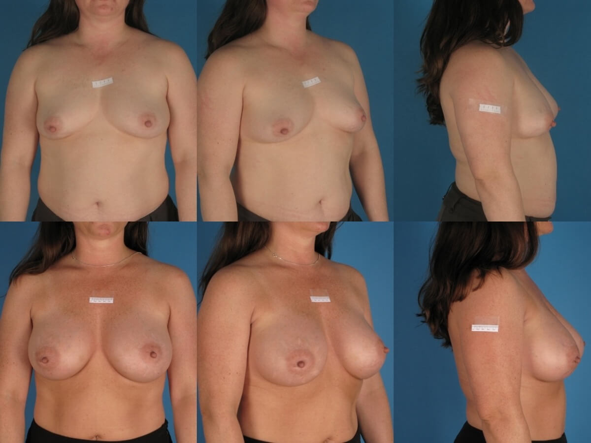 Breast Augmentation Patient 23 | Before and After Breast Augmentation 1