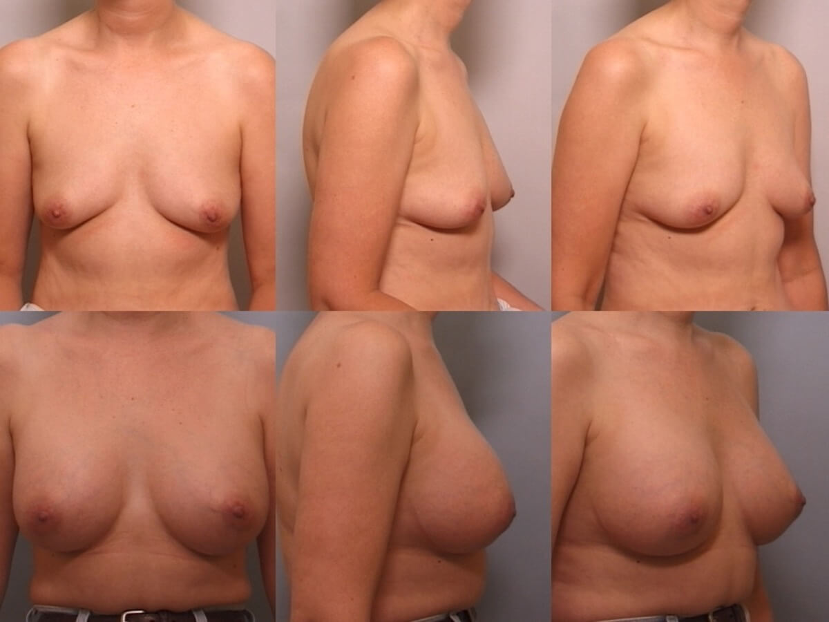 Breast Augmentation Patient 25 | Before and After Breast Augmentation 1