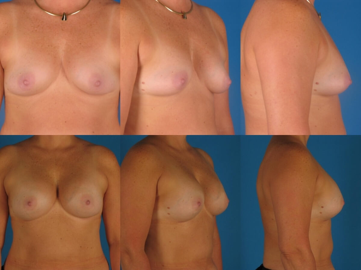 Breast Augmentation Patient 27 | Before and After Breast Augmentation 1