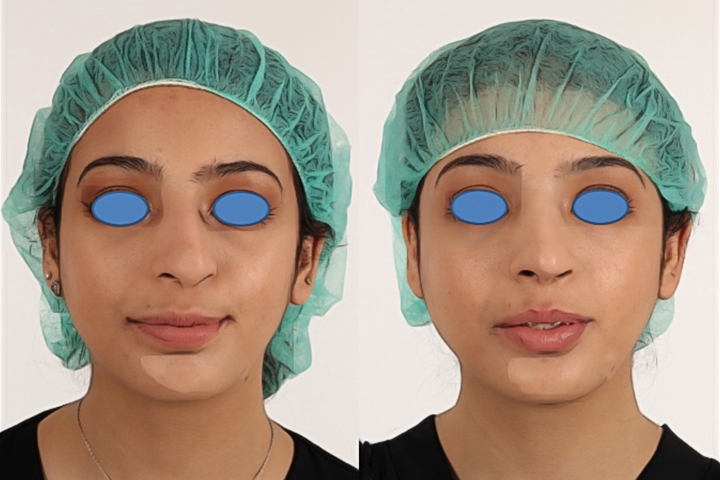 Rhinoplasty Patient 2 - Dr. Aly in Dallas Texas - Before and After Patient View 1