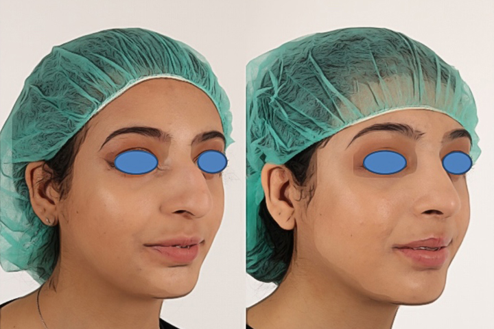 Rhinoplasty Patient 2 - Dr. Aly in Dallas Texas - Before and After Patient View 2