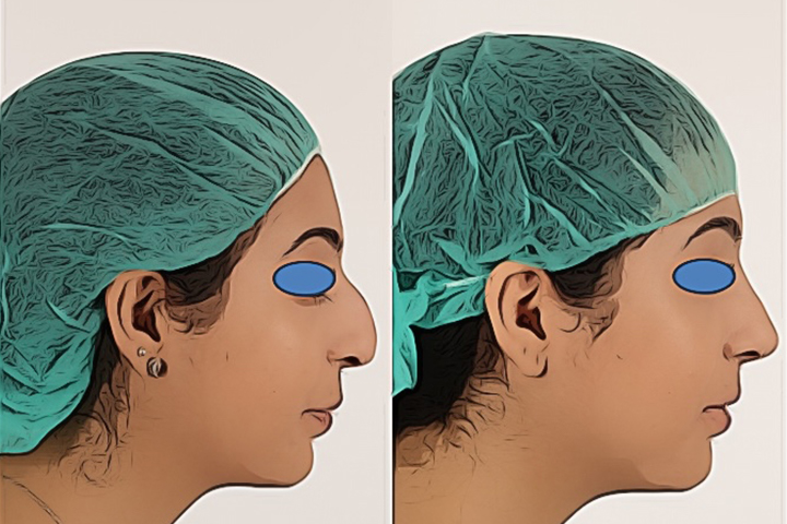 Rhinoplasty Patient 2 - Dr. Aly in Dallas Texas - Before and After Patient View 3